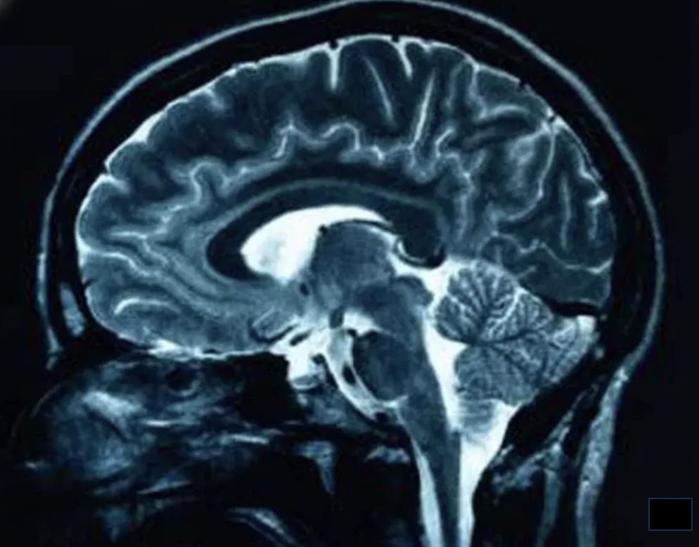 Brain MRI scan - sagittal view showing detailed brain structures